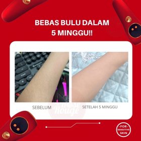 IPL Dingin - Hair Removal Laser Portable (Black)
