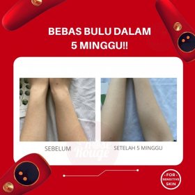 IPL Dingin - Hair Removal Laser Portable (Black)