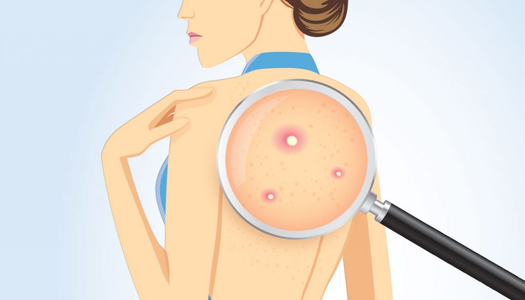 treatments-for-back-acne-1076×615